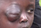 10-YEAR-OLD GIRL BATTLES SEVERE EYE SWELLING AS FAMILY PLEADS FOR KSH 150,000 LIFESAVING TREATMENT