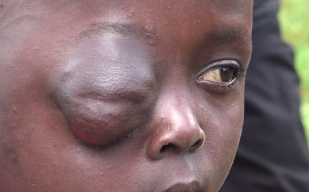 10-YEAR-OLD GIRL BATTLES SEVERE EYE SWELLING AS FAMILY PLEADS FOR KSH 150,000 LIFESAVING TREATMENT