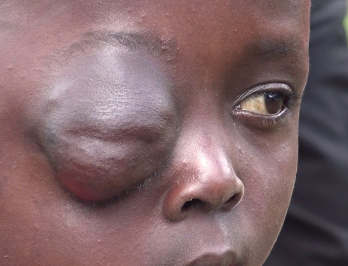 10-YEAR-OLD GIRL BATTLES SEVERE EYE SWELLING AS FAMILY PLEADS FOR KSH 150,000 LIFESAVING TREATMENT