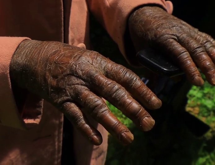 NYAMIRA MOTHER BATTLING RARE SKIN DISEASE SEEKS HELP FOR TREATMENT AND CHILDREN’S SCHOOL FEES