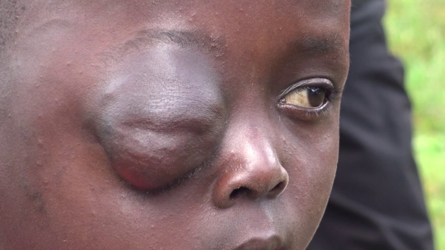 10-YEAR-OLD GIRL BATTLES SEVERE EYE SWELLING AS FAMILY PLEADS FOR KSH 150,000 LIFESAVING TREATMENT